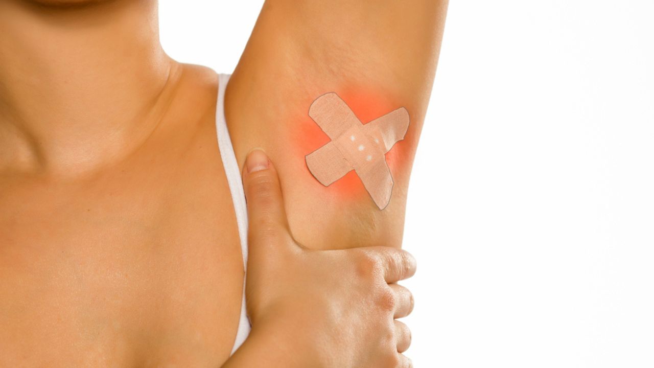 Aisselle irritée après une épilation, avec un pansement appliqué sur la zone rouge et enflammée.